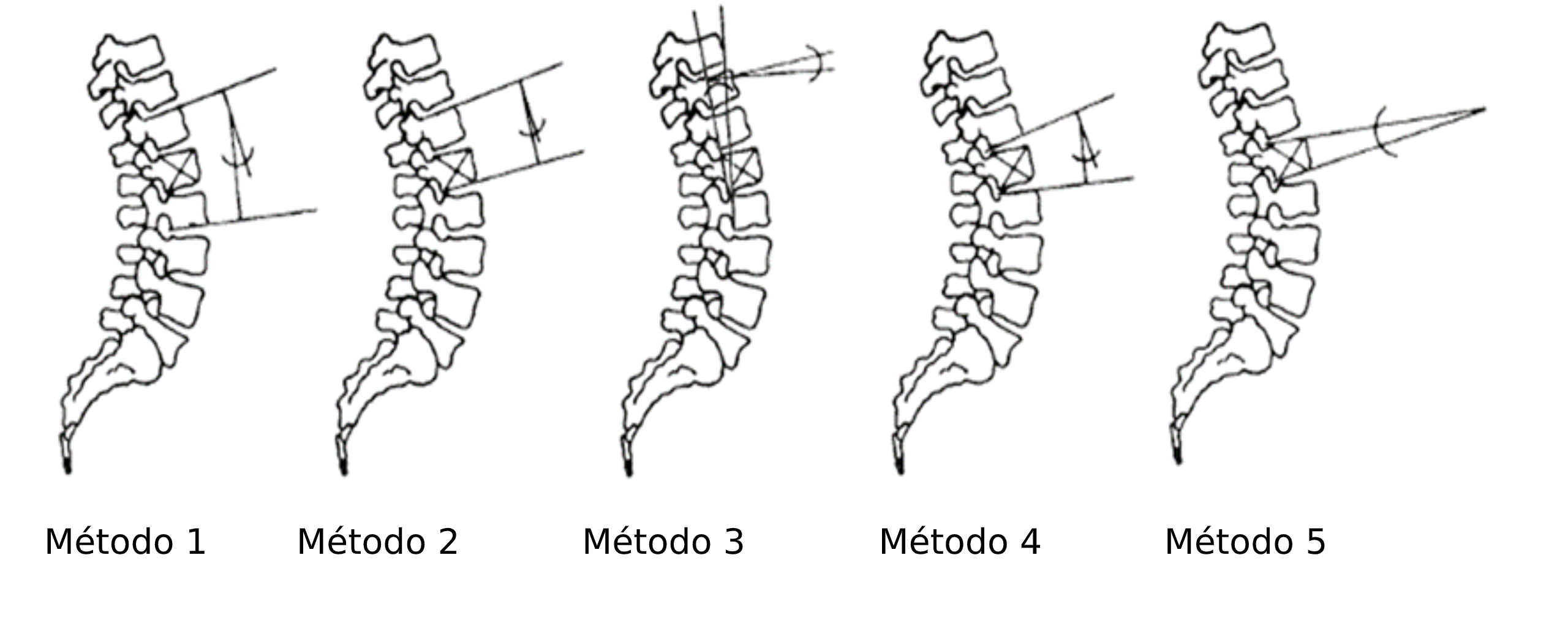 Métodos disponibles para la cuantificación y diagnóstico de fracturas por compresión de fracturas vertebrales (modificado de Kuklo et al., 2001).